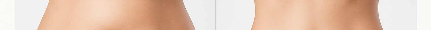 Cavitation Liposuction Before and After