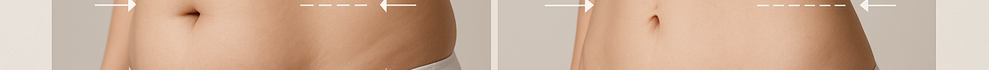 Lipo Laser Before and After: Real Patient Results
