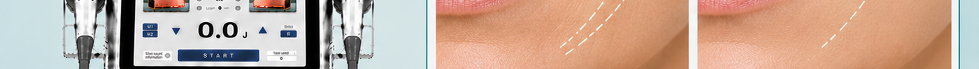 7D HIFU for Smile Lines: Before and After Photos