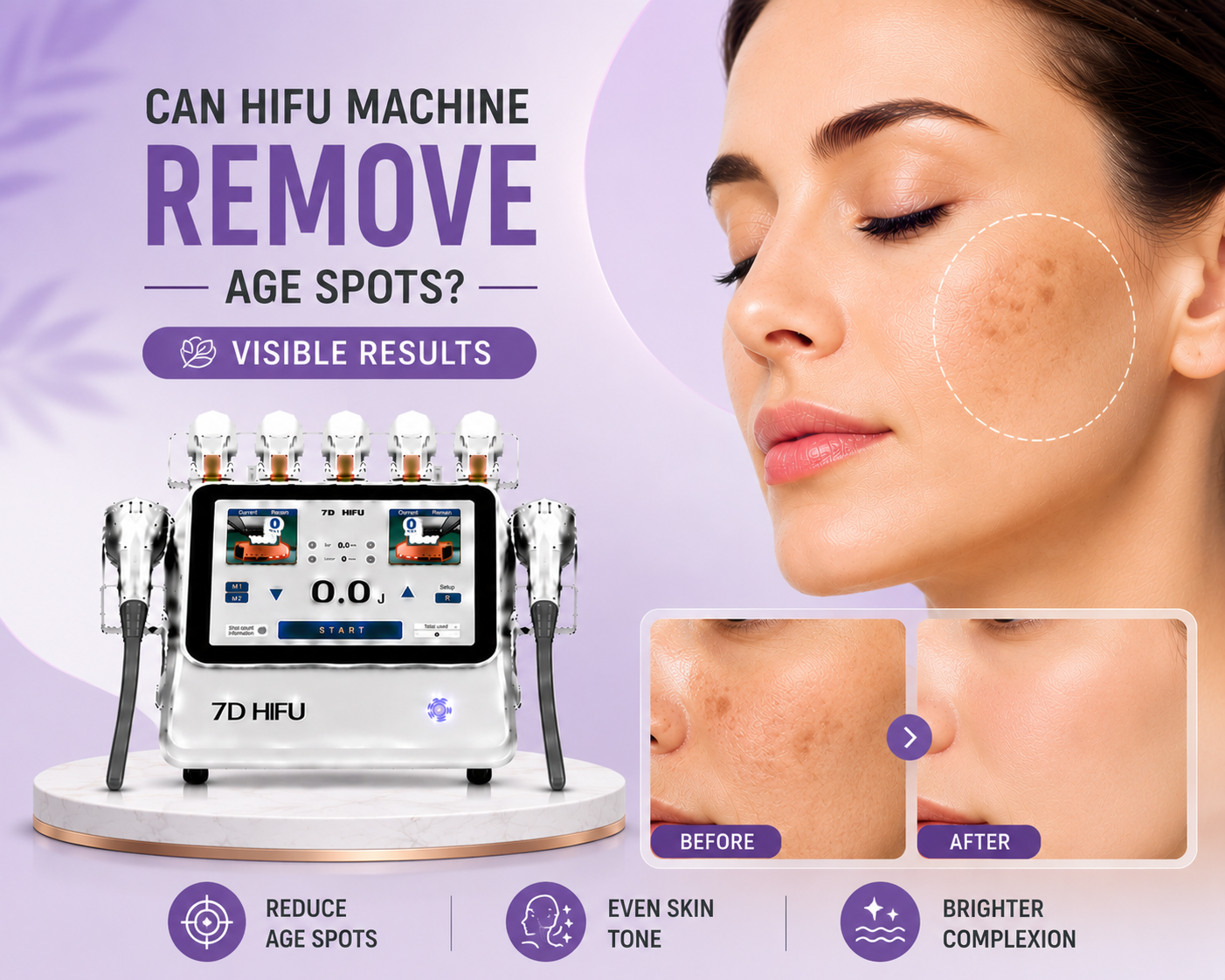 Can HIFU Machine Remove Age Spots?