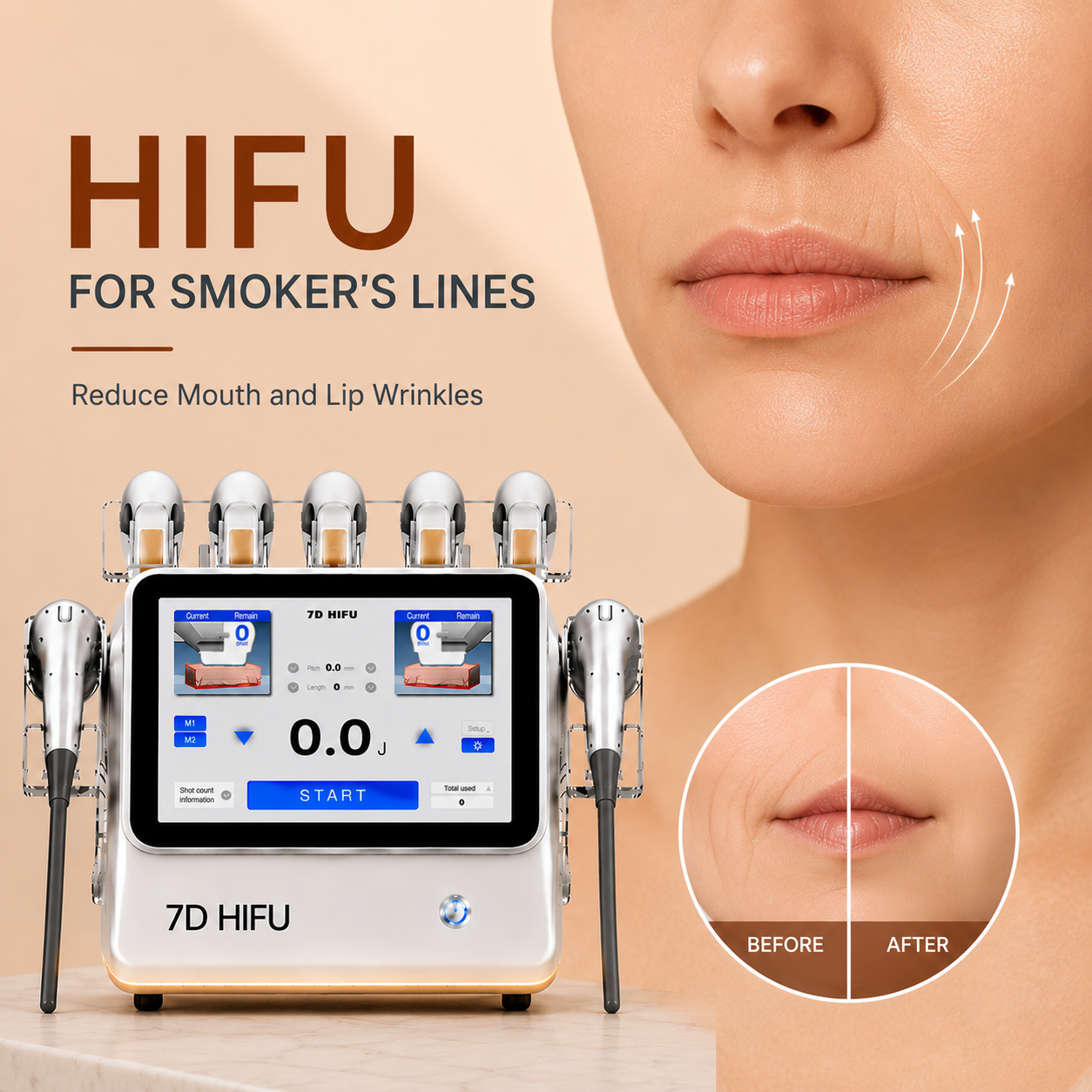 HIFU for Smoker's Lines: Reduce Mouth and Lip Wrinkles