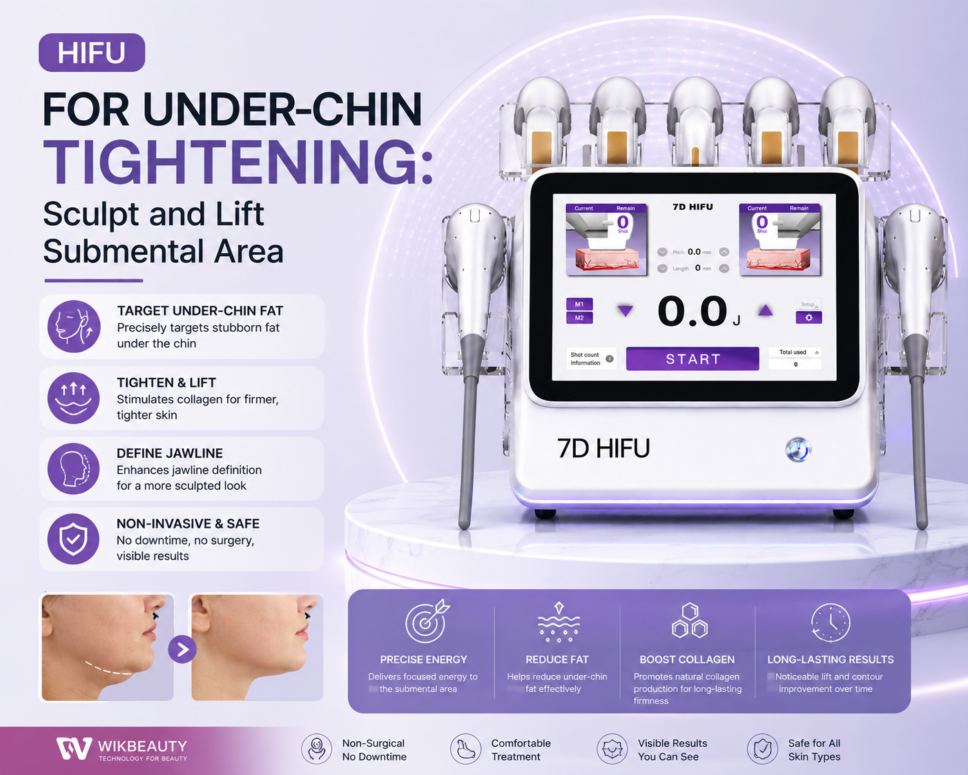 HIFU for Under-Chin Tightening: Sculpt and Lift Submental Area