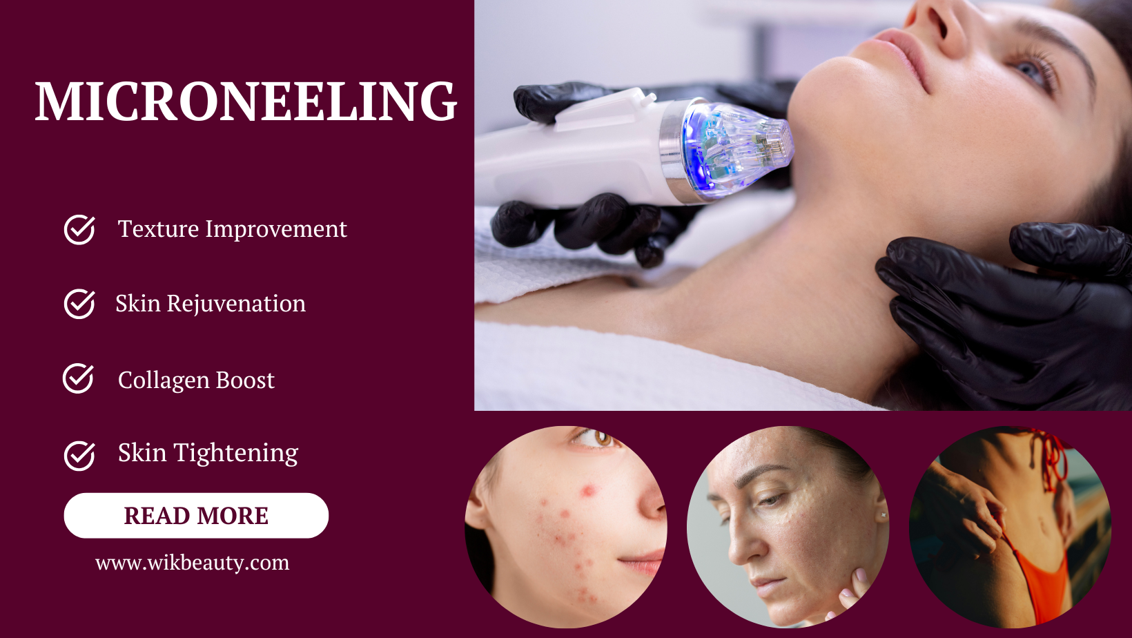 The Ultimate Guide to Finding the Best Type of Microneedling for Your Skin