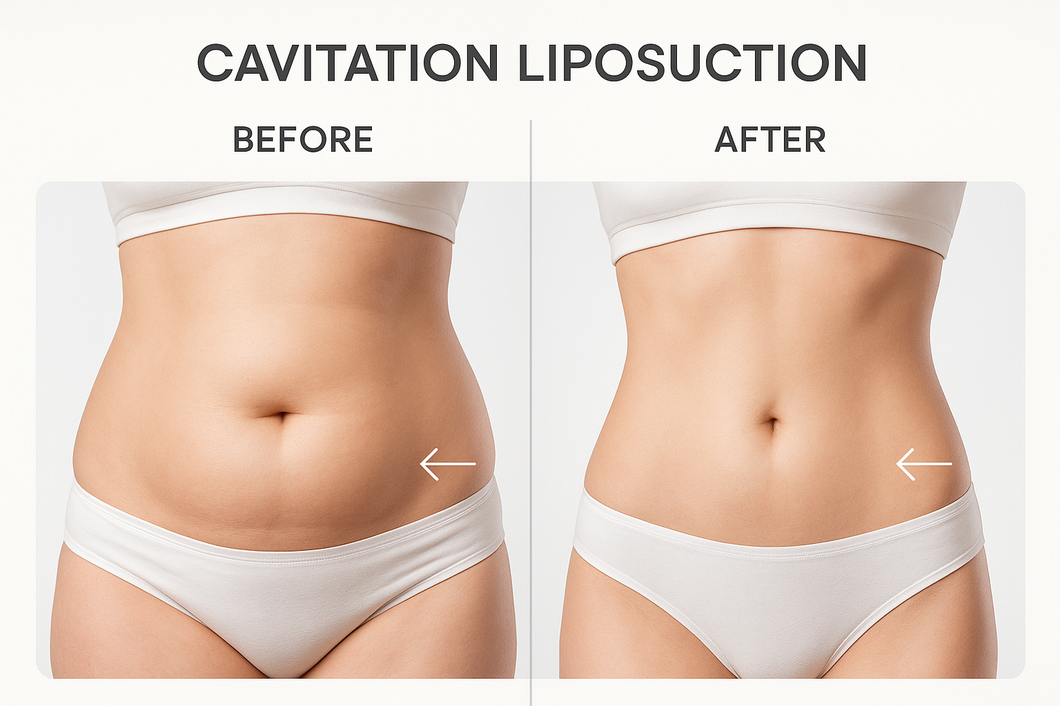 Cavitation Liposuction Before and After