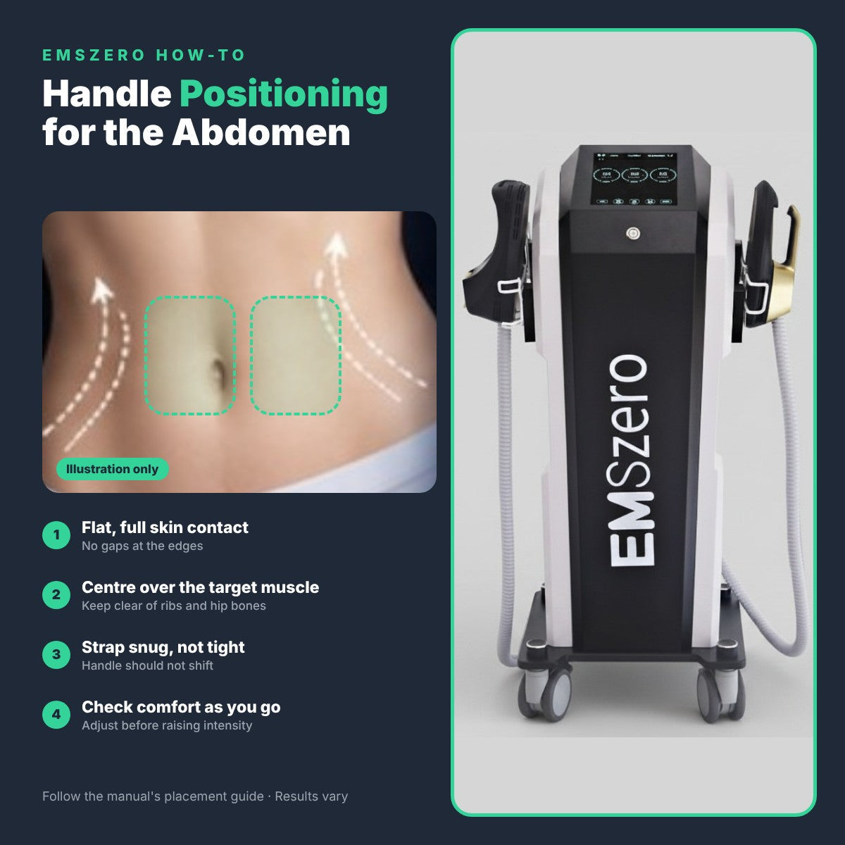 EMSzero Handle Positioning for Abdominal Contouring