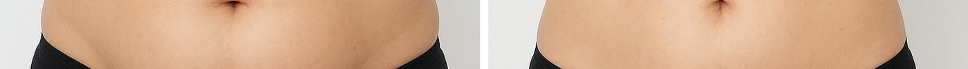 Real Results of Laser Lipolysis – WIKBeauty Devices